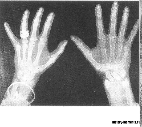 Руки герцога и герцогини Кентских одними из первых попали под рентген (1896).